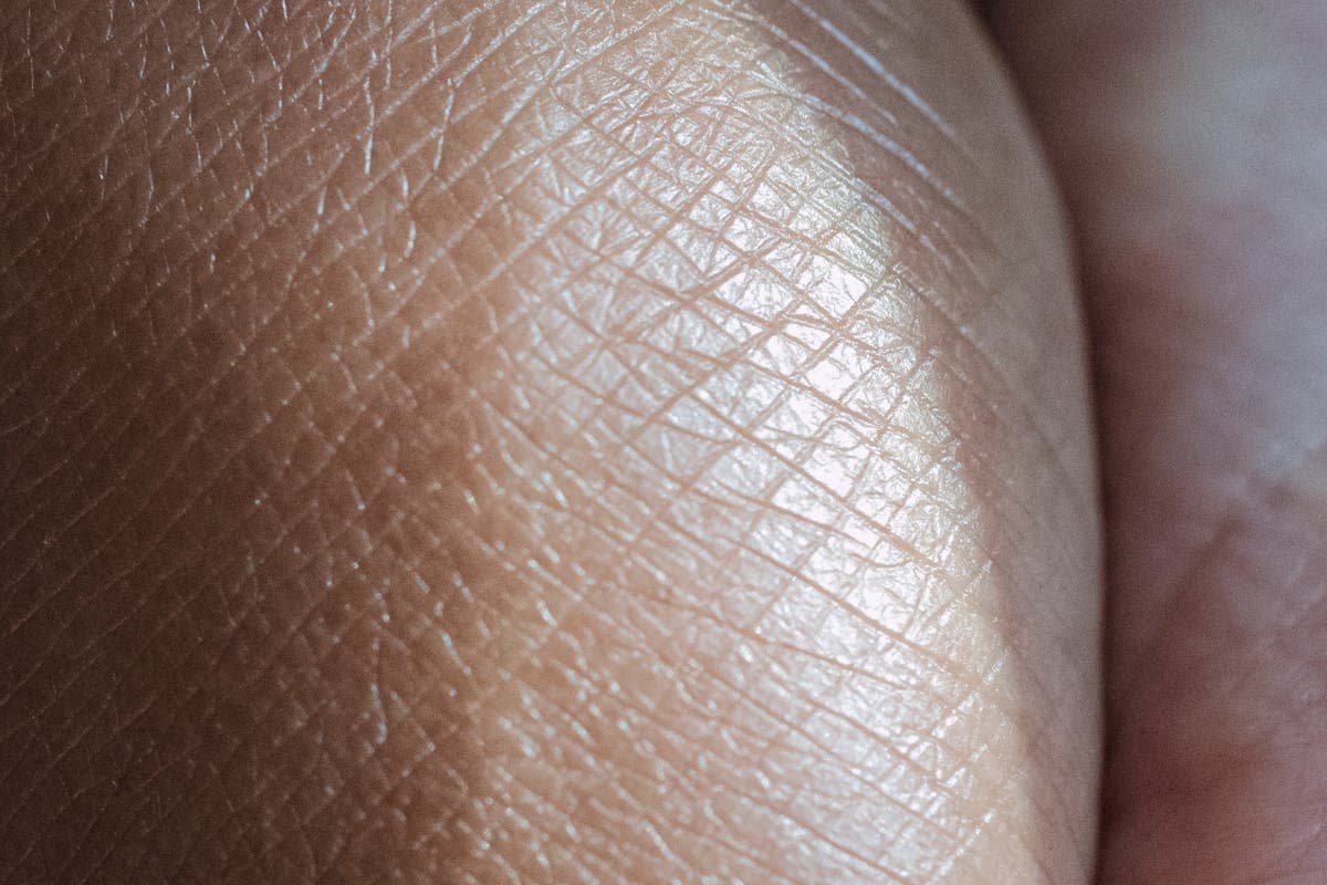 Orticaria e prurito cutaneo in estate: antistaminici e creme
